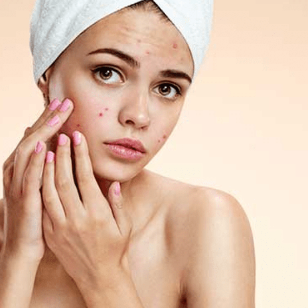 Treatment for Acne Skin